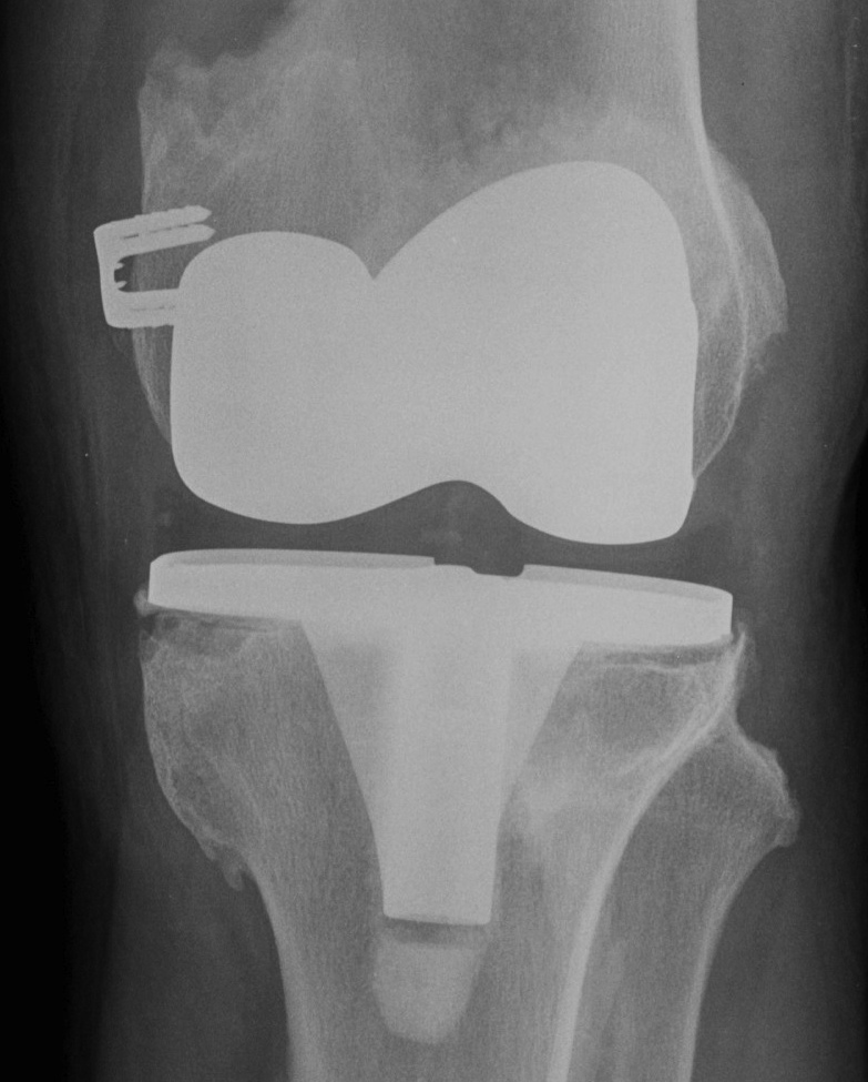 Revision TKR Tibial Lysis